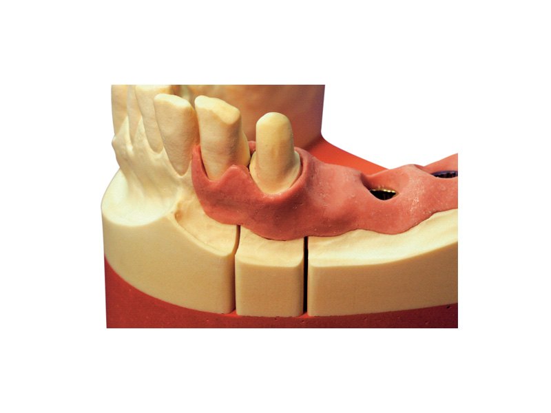 Picodent Majesthetik-Gingimplant - 2 X 50 ml + 12 canules
